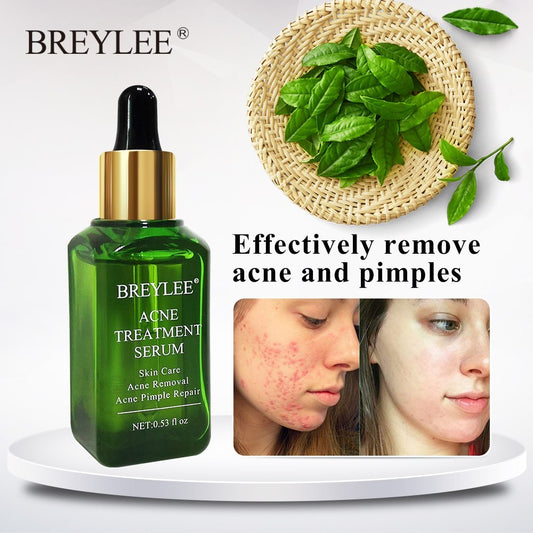 BREYLEE Acne Treatment Serum Face Facial Anti Acne Scar Removal Cream Skin Care Whitening Repair Pimple Remover For Acne